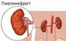 Пиелонефрит почек